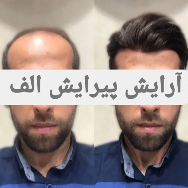 پروتز مو - آرایش و پیرایش الف بیرجند