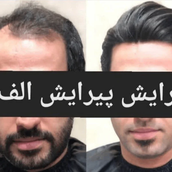 پروتز مو - آرایش و پیرایش الف بیرجند