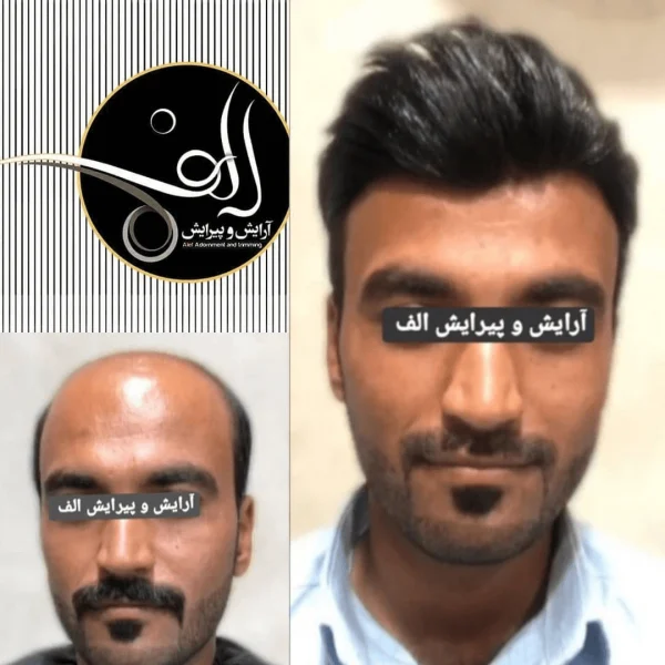 پروتز مو - آرایش و پیرایش الف بیرجند